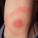 Surprised to learn tick bite could be so serious